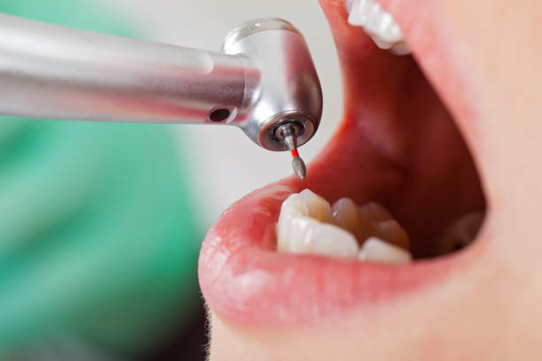 Best Knocked-Out Tooth (Avulsed Tooth) Treatment in Weyers Cave, VA